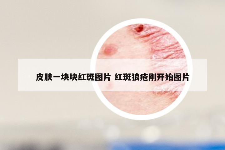 皮肤一块块红斑图片 红斑狼疮刚开始图片