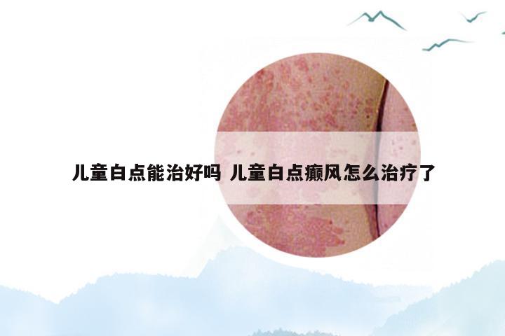 儿童白点能治好吗 儿童白点癫风怎么治疗了