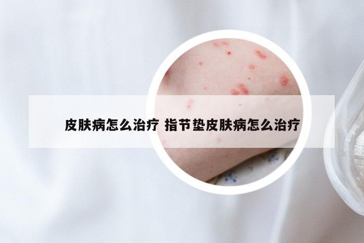 皮肤病怎么治疗 指节垫皮肤病怎么治疗