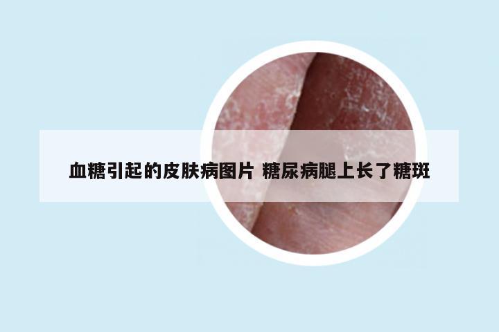 血糖引起的皮肤病图片 糖尿病腿上长了糖斑