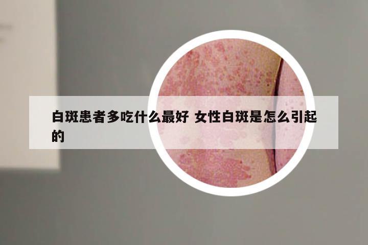 白斑患者多吃什么最好 女性白斑是怎么引起的