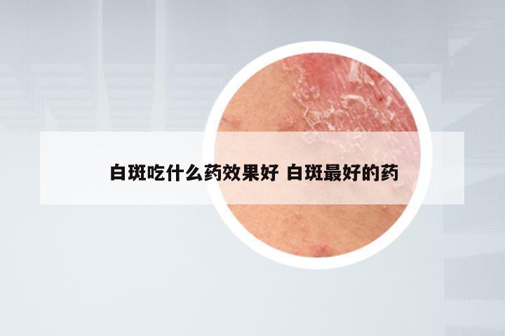白斑吃什么药效果好 白斑最好的药