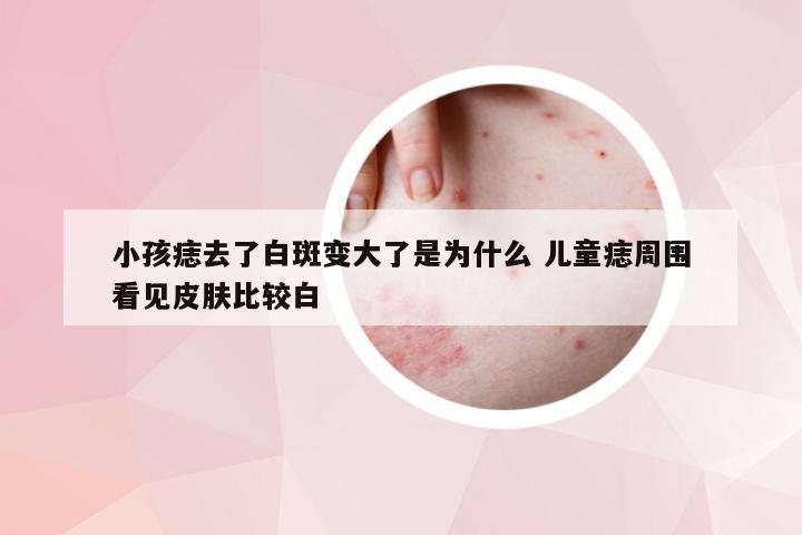 小孩痣去了白斑变大了是为什么 儿童痣周围看见皮肤比较白