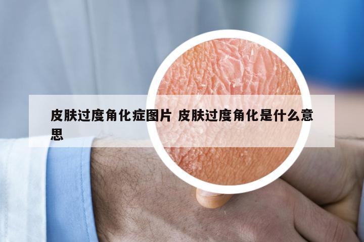 皮肤过度角化症图片 皮肤过度角化是什么意思