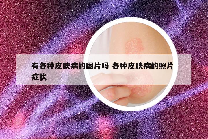 有各种皮肤病的图片吗 各种皮肤病的照片 症状