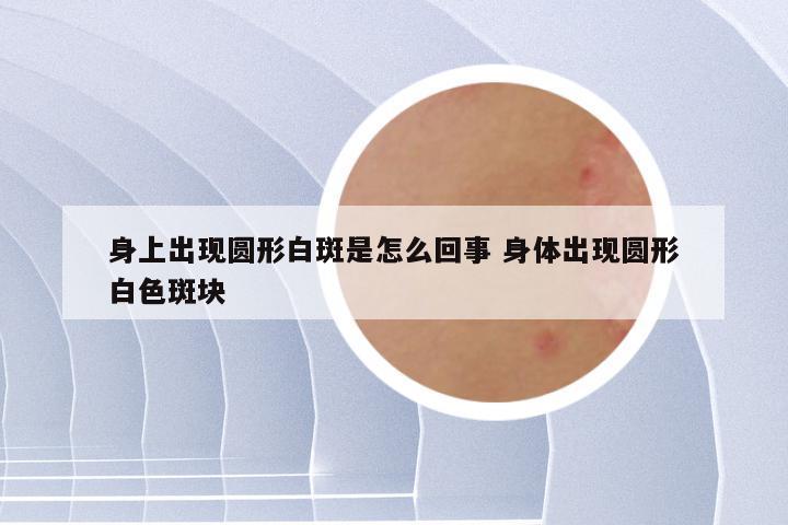 身上出现圆形白斑是怎么回事 身体出现圆形白色斑块