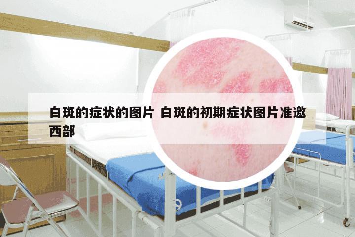 白斑的症状的图片 白斑的初期症状图片准邀西部