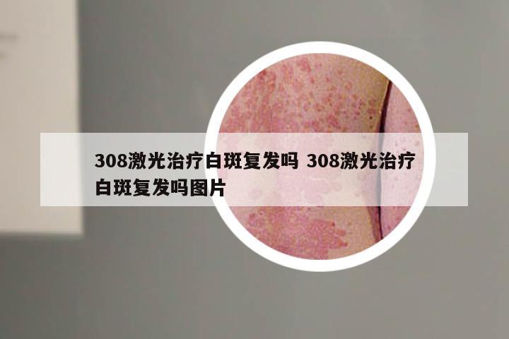308激光治疗白斑复发吗 308激光治疗白斑复发吗图片