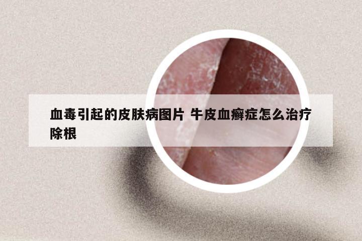 血毒引起的皮肤病图片 牛皮血癣症怎么治疗除根