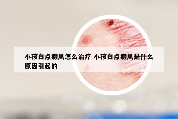 小孩白点癫风怎么治疗 小孩白点癫风是什么原因引起的