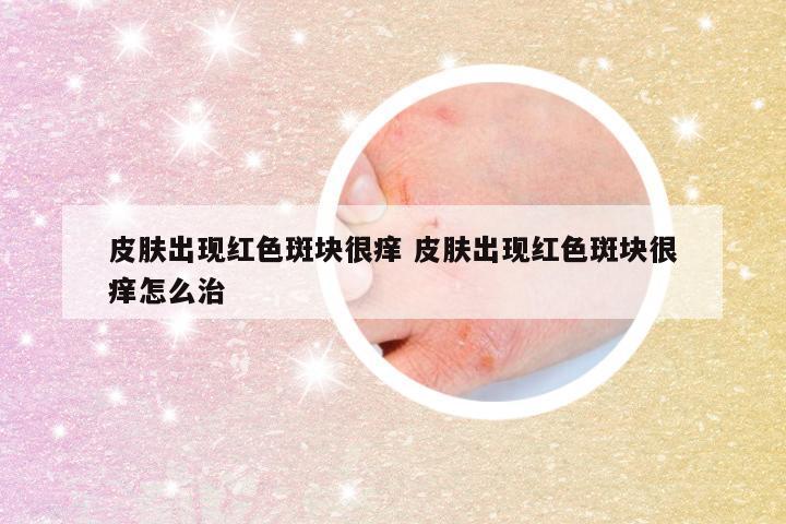 皮肤出现红色斑块很痒 皮肤出现红色斑块很痒怎么治