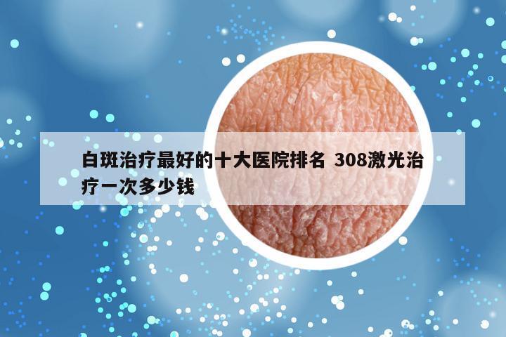 白斑治疗最好的十大医院排名 308激光治疗一次多少钱