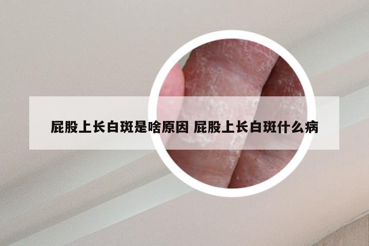 屁股上长白斑是啥原因 屁股上长白斑什么病