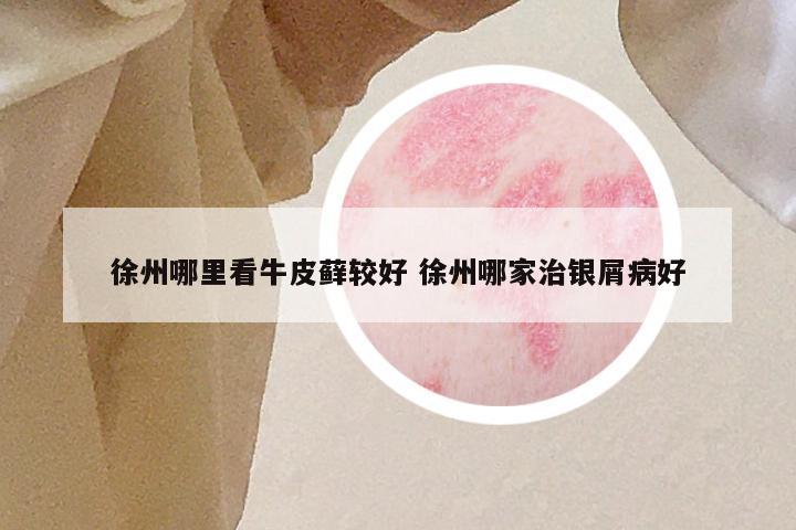 徐州哪里看牛皮藓较好 徐州哪家治银屑病好