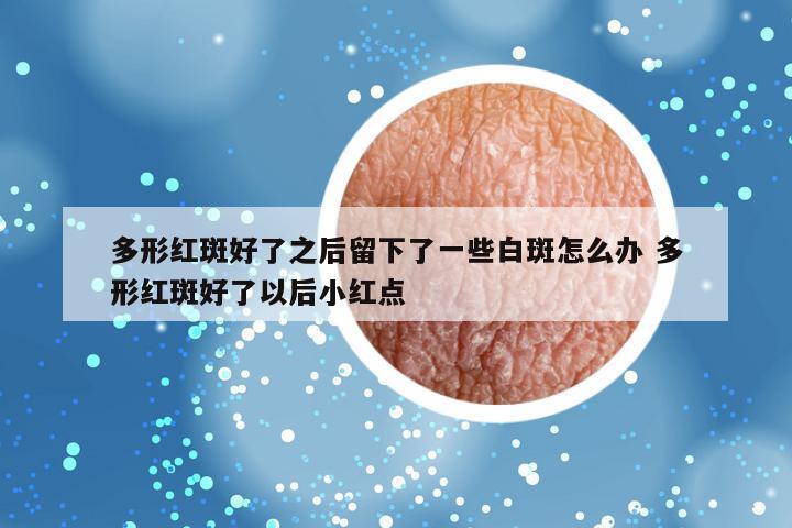 多形红斑好了之后留下了一些白斑怎么办 多形红斑好了以后小红点