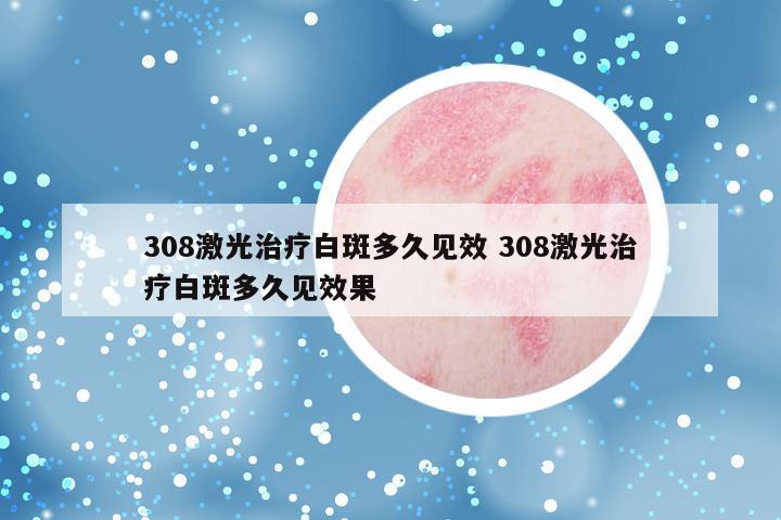 308激光治疗白斑多久见效 308激光治疗白斑多久见效果