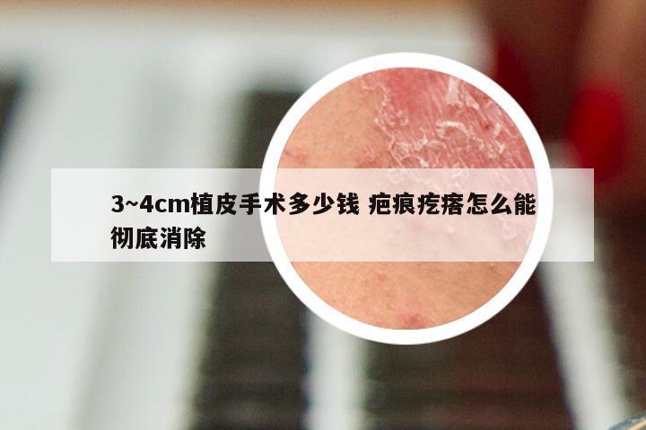 3～4cm植皮手术多少钱 疤痕疙瘩怎么能彻底消除