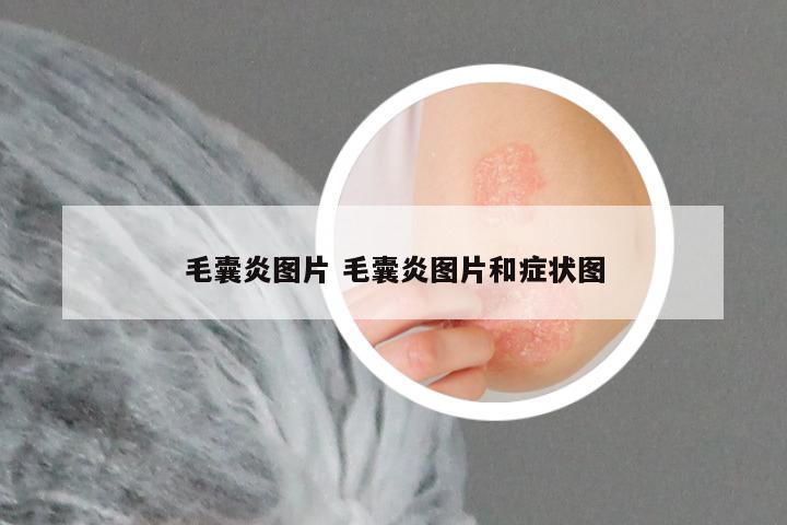 毛囊炎图片 毛囊炎图片和症状图