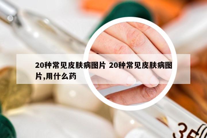 20种常见皮肤病图片 20种常见皮肤病图片,用什么药