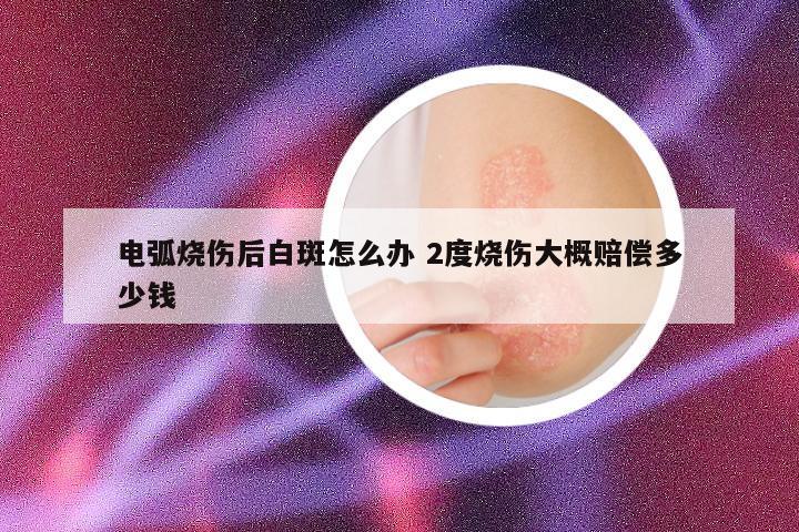 电弧烧伤后白斑怎么办 2度烧伤大概赔偿多少钱