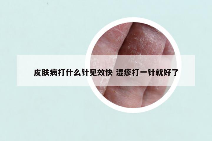 皮肤病打什么针见效快 湿疹打一针就好了