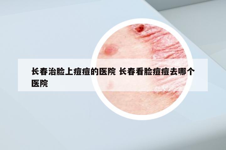 长春治脸上痘痘的医院 长春看脸痘痘去哪个医院