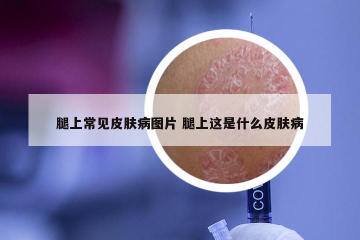 腿上常见皮肤病图片 腿上这是什么皮肤病