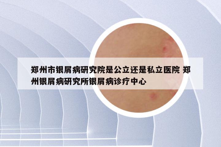 郑州市银屑病研究院是公立还是私立医院 郑州银屑病研究所银屑病诊疗中心