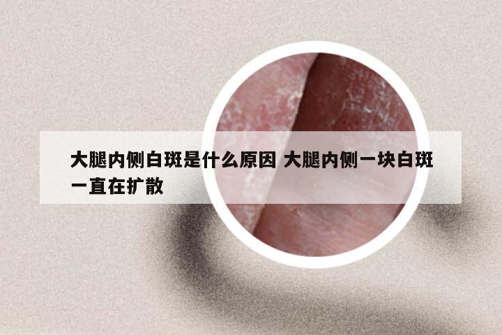 大腿内侧白斑是什么原因 大腿内侧一块白斑一直在扩散