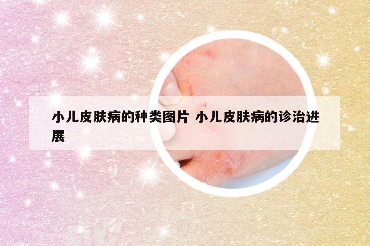小儿皮肤病的种类图片 小儿皮肤病的诊治进展