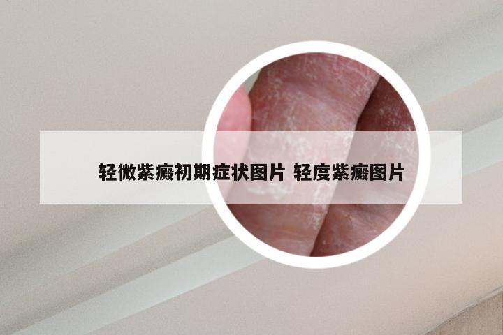 轻微紫癜初期症状图片 轻度紫癜图片