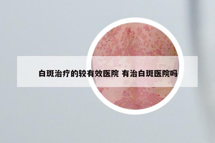 白斑治疗的较有效医院 有治白斑医院吗