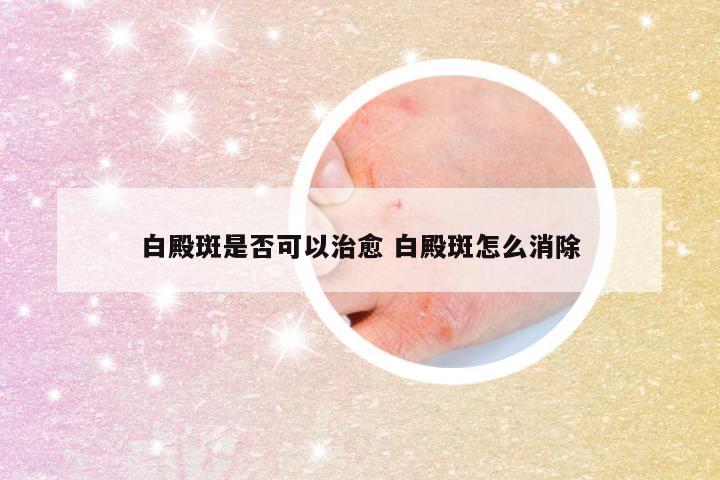 白殿斑是否可以治愈 白殿斑怎么消除