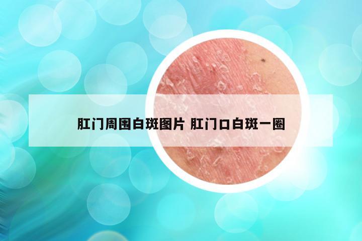 肛门周围白斑图片 肛门口白斑一圈