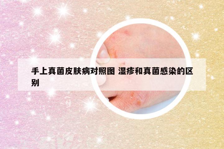 手上真菌皮肤病对照图 湿疹和真菌感染的区别