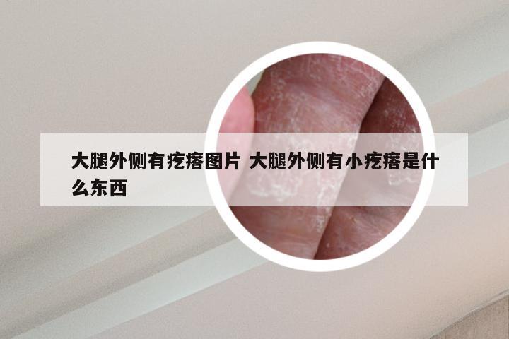 大腿外侧有疙瘩图片 大腿外侧有小疙瘩是什么东西