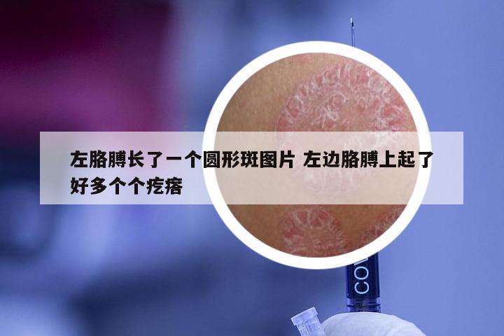 左胳膊长了一个圆形斑图片 左边胳膊上起了好多个个疙瘩