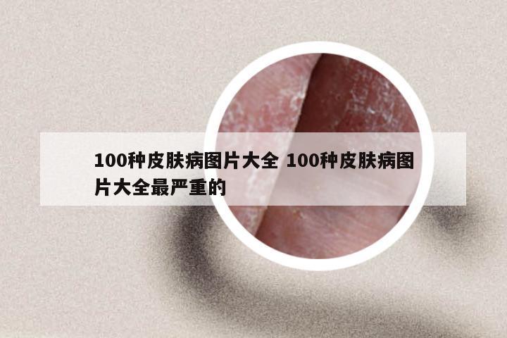 100种皮肤病图片大全 100种皮肤病图片大全最严重的