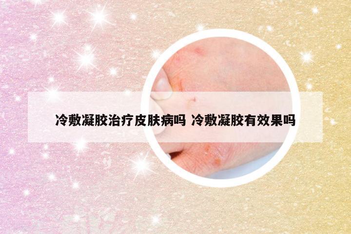 冷敷凝胶治疗皮肤病吗 冷敷凝胶有效果吗