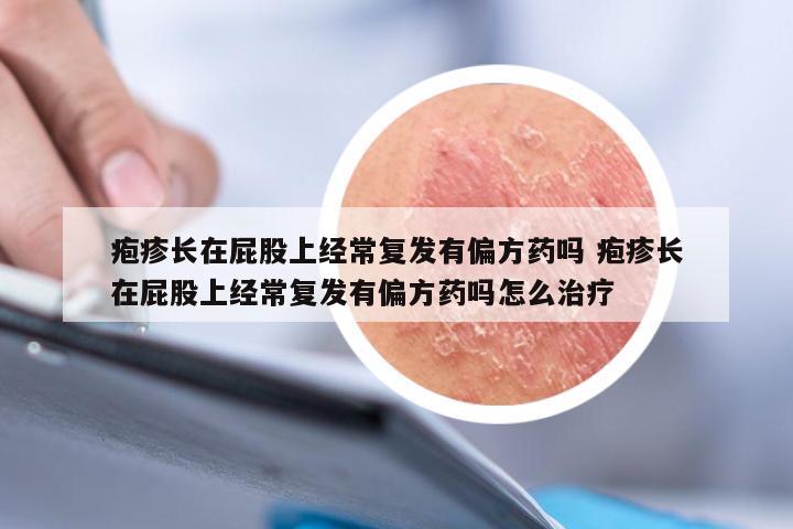 疱疹长在屁股上经常复发有偏方药吗 疱疹长在屁股上经常复发有偏方药吗怎么治疗