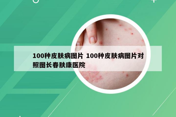 100种皮肤病图片 100种皮肤病图片对照图长春肤康医院