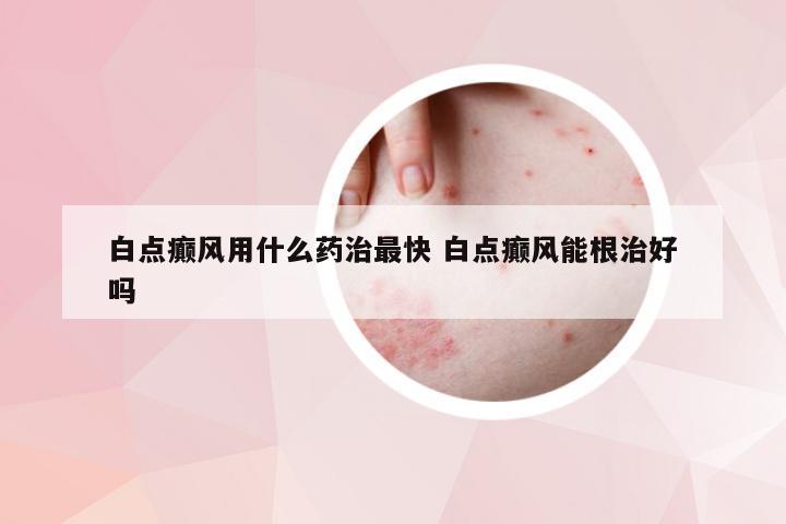 白点癫风用什么药治最快 白点癫风能根治好吗