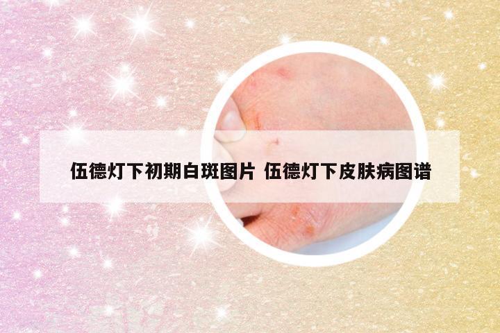 伍德灯下初期白斑图片 伍德灯下皮肤病图谱