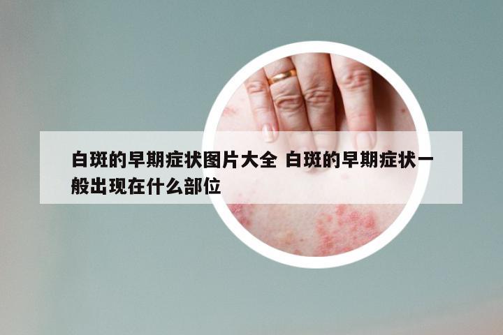白斑的早期症状图片大全 白斑的早期症状一般出现在什么部位
