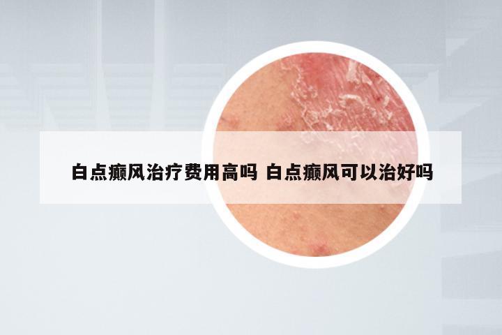 白点癫风治疗费用高吗 白点癫风可以治好吗