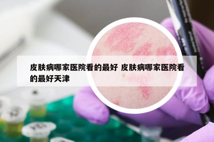 皮肤病哪家医院看的最好 皮肤病哪家医院看的最好天津
