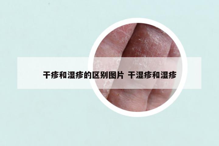 干疹和湿疹的区别图片 干湿疹和湿疹