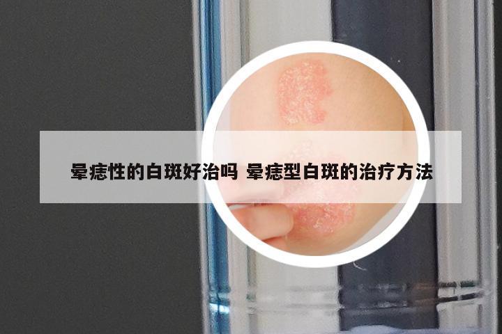 晕痣性的白斑好治吗 晕痣型白斑的治疗方法