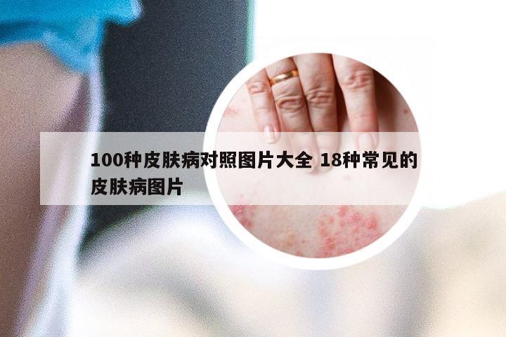 100种皮肤病对照图片大全 18种常见的皮肤病图片