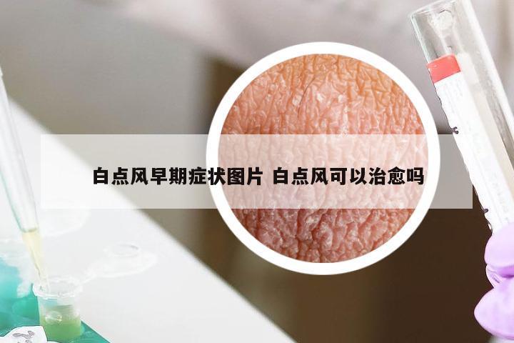 白点风早期症状图片 白点风可以治愈吗